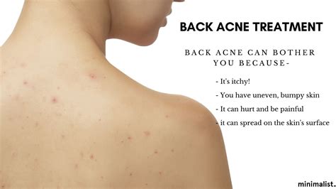 What Causes Acne On Back And Shoulders